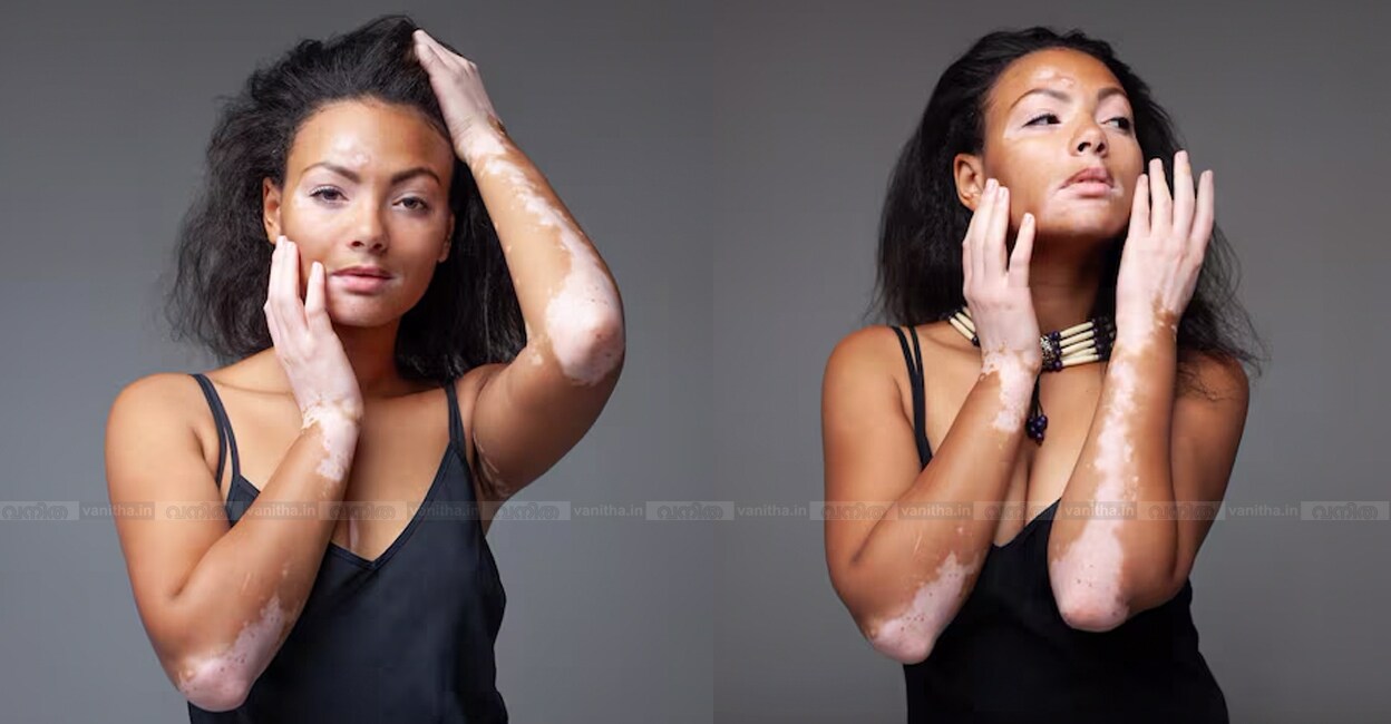 vitiligo-treatment-cover