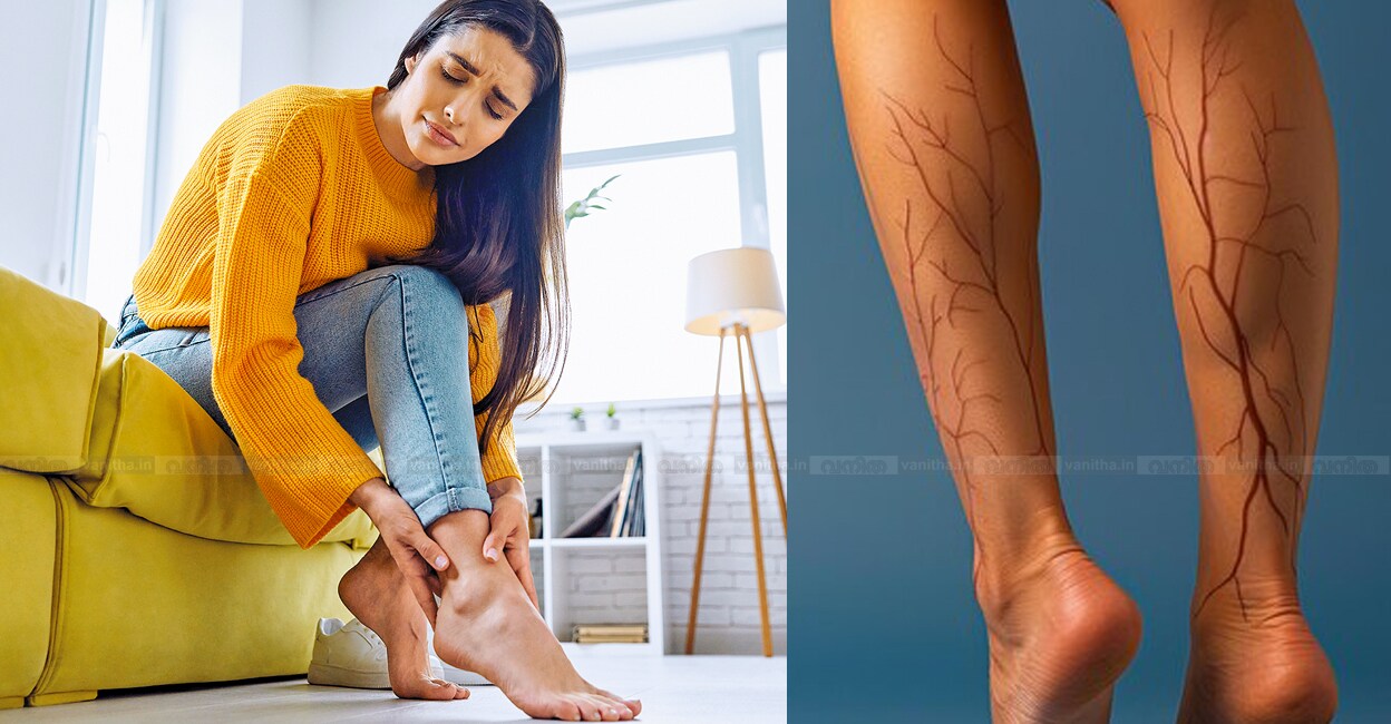 Varicose-Veins-surgery