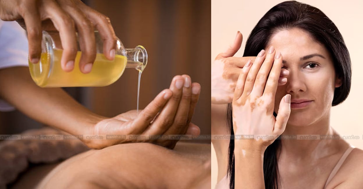 ayurvedic-treatment-vitiligo