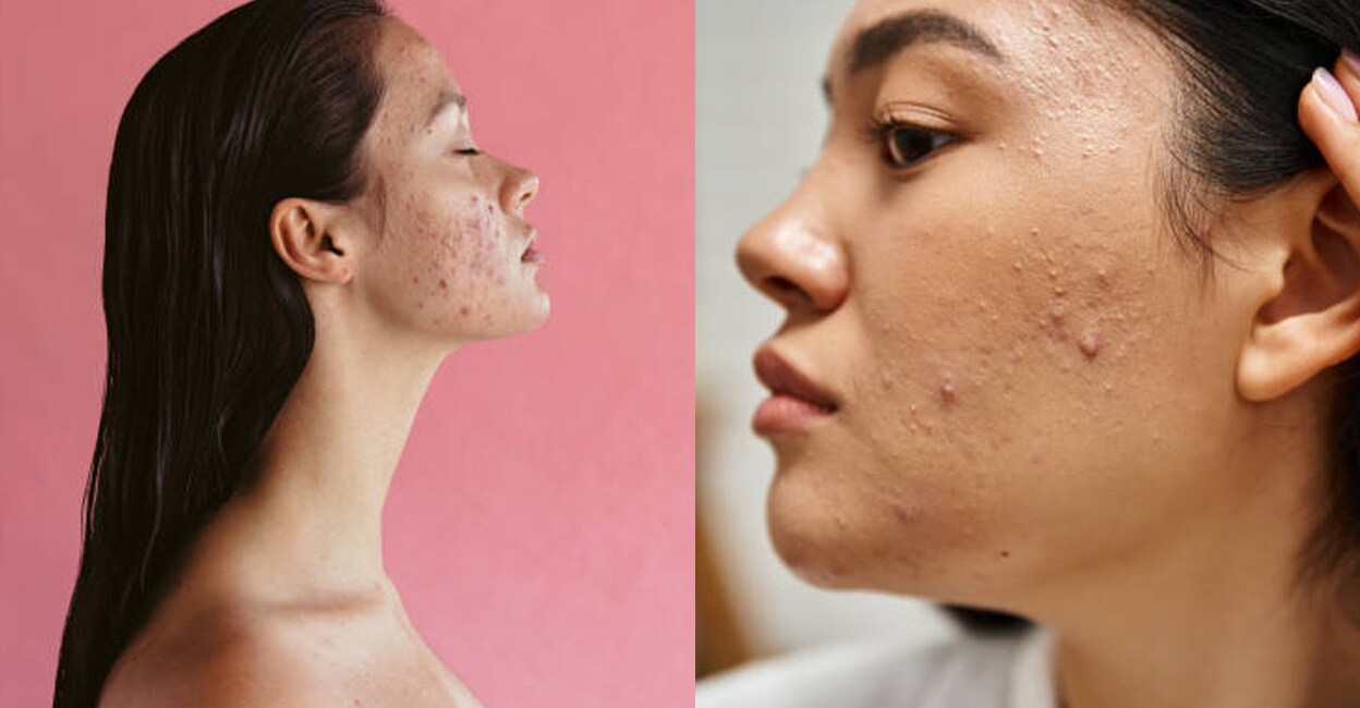 acne-pimple-care-home-remedies-beauty-tips