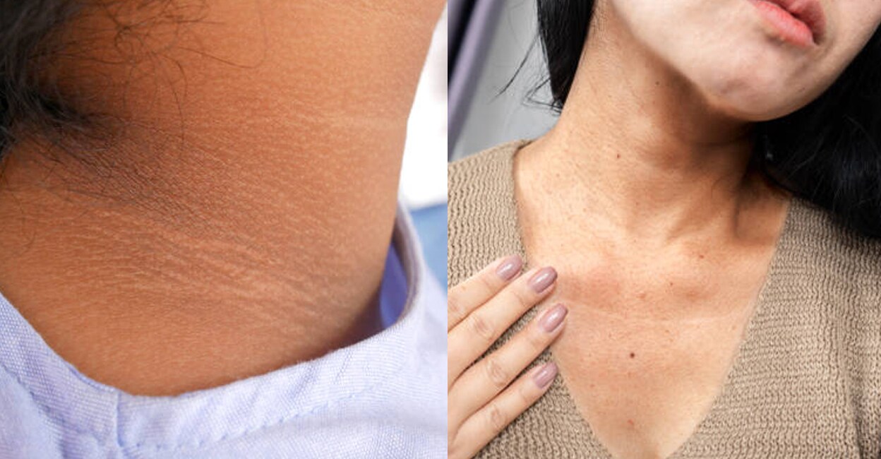 dark-circle-around-neck