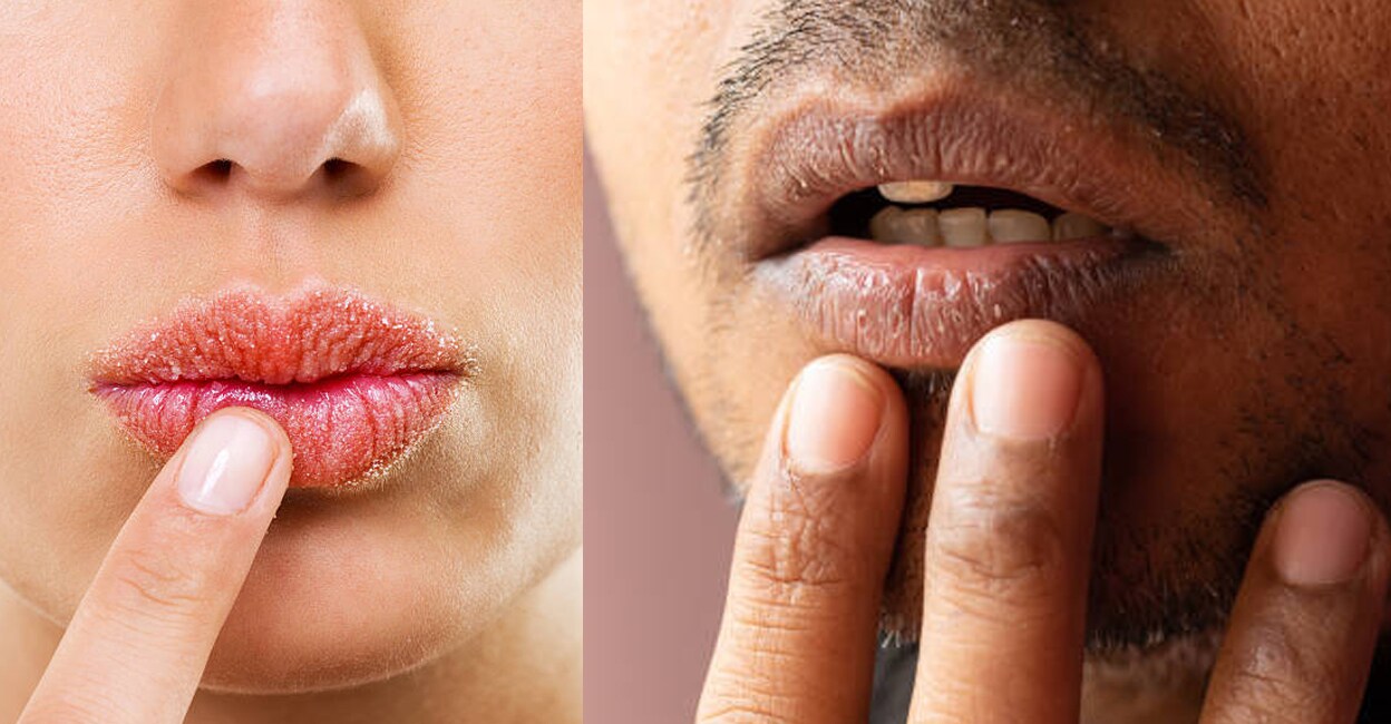 dry-lips-remedies-at-home-in-winter-season