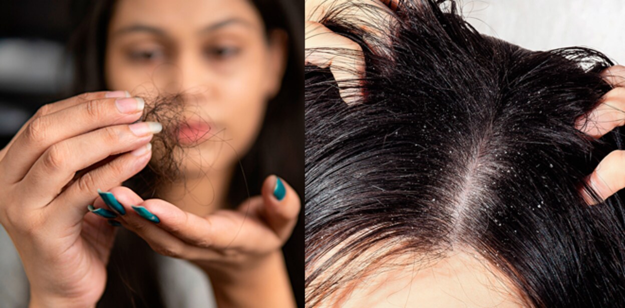 dandruff-oils-new