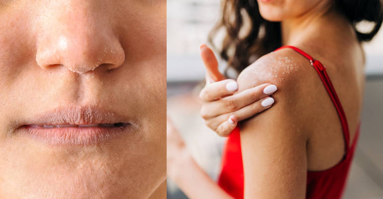dry-skin-tips