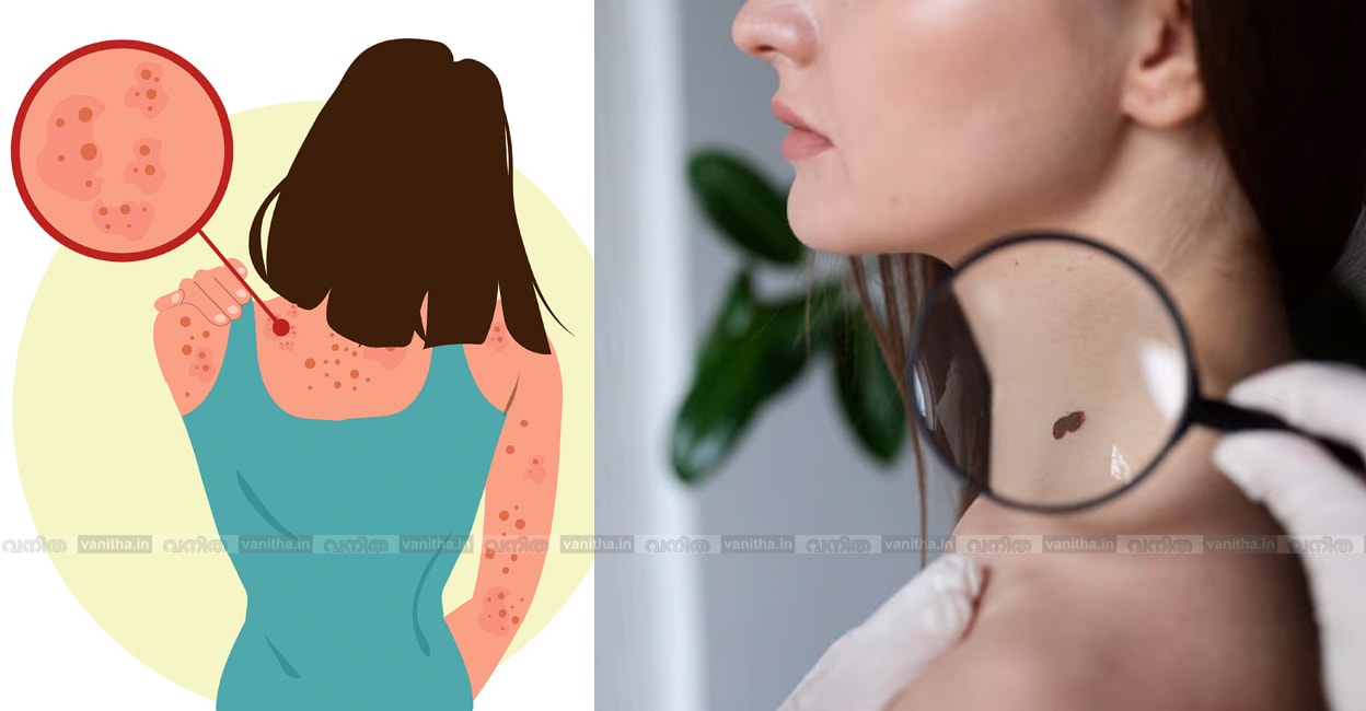 warts-on-face