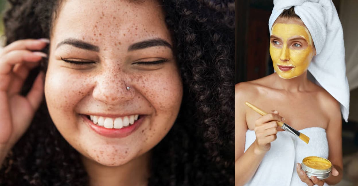 freckles