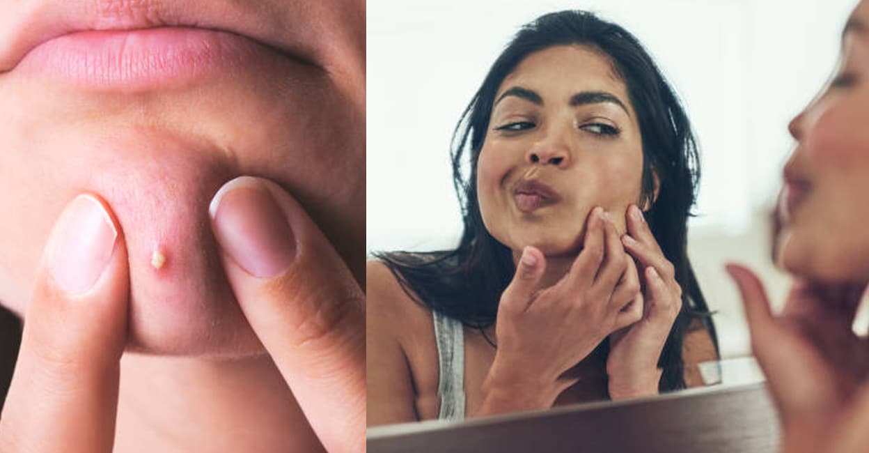 The-Dangers-of-Popping-Pimples