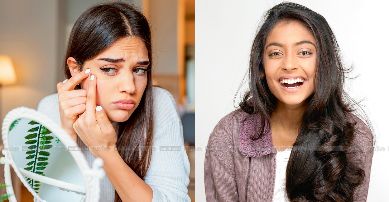 beauty-tips-for-teenagers-adolescent-acne