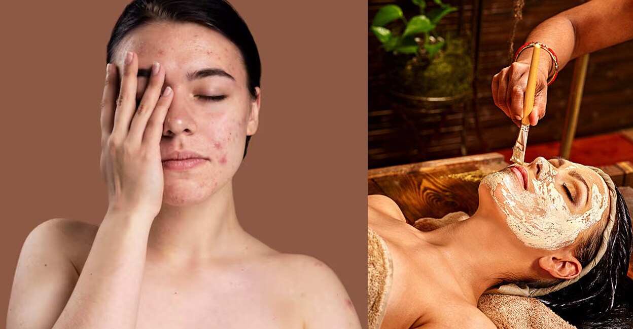 ayurveda-for-pimples