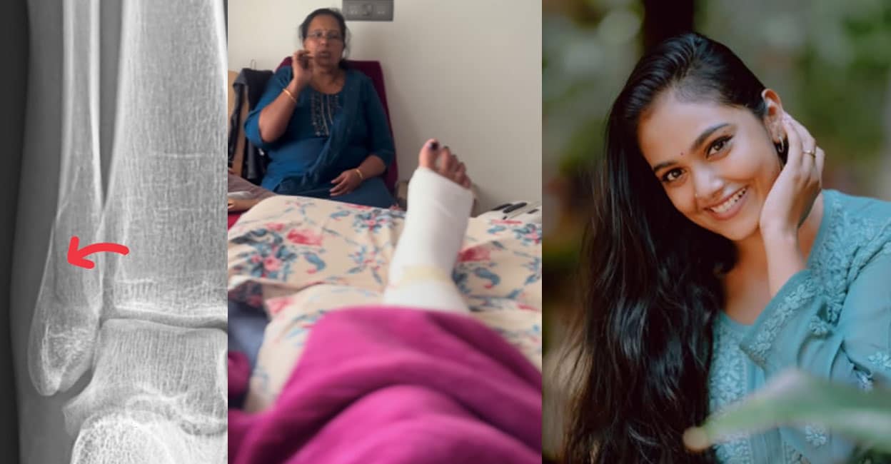 rebecca-santhosh-fracture