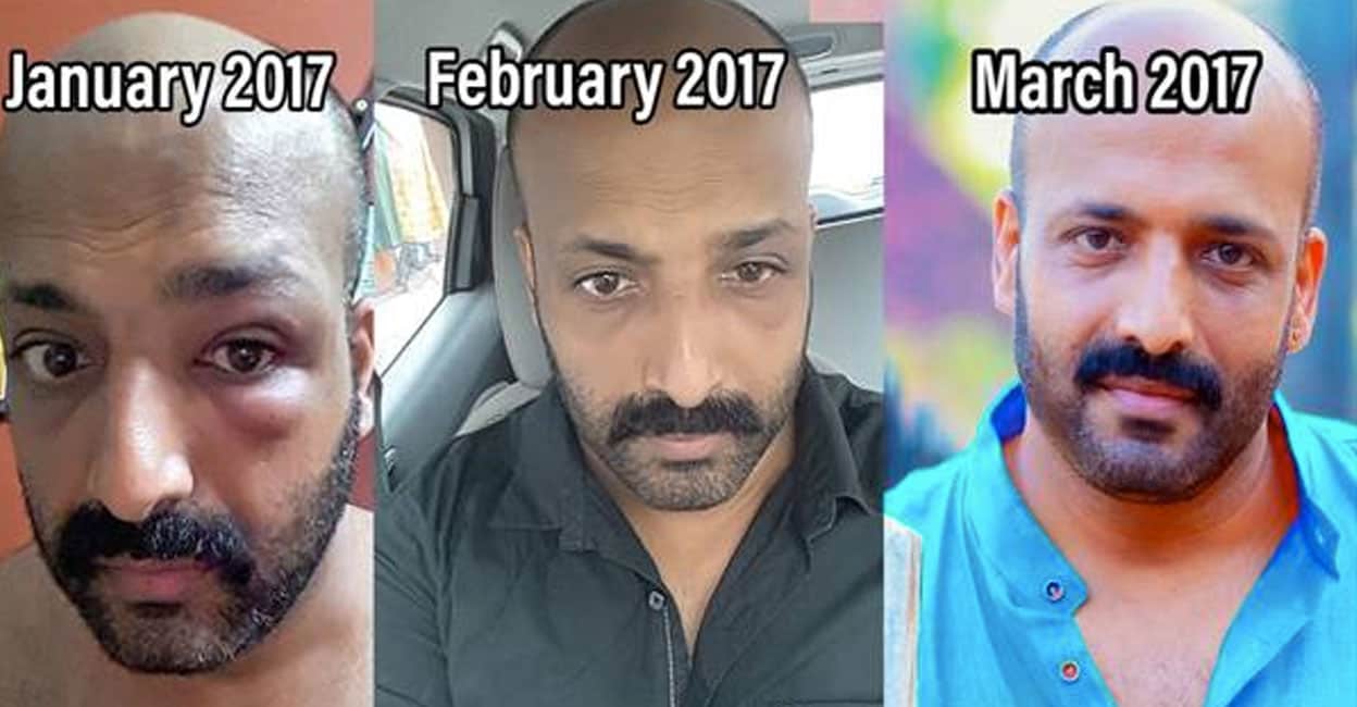 mb-padmakumar-health-story