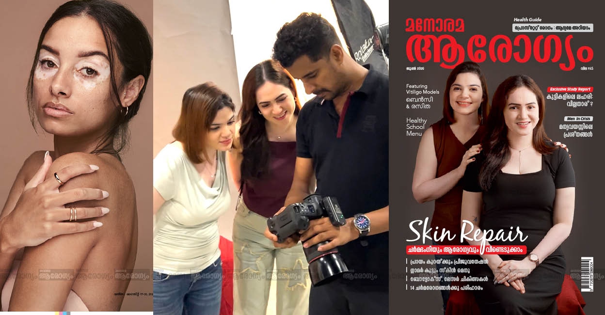 vitiligo-cover