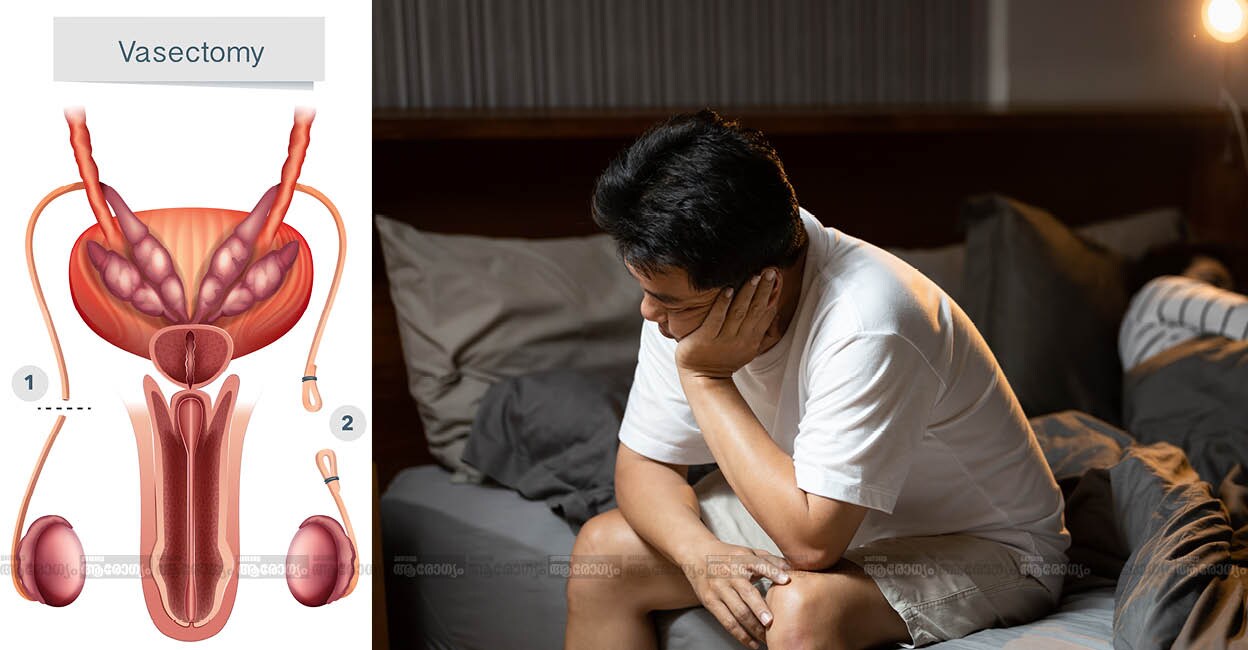 vasectomy45