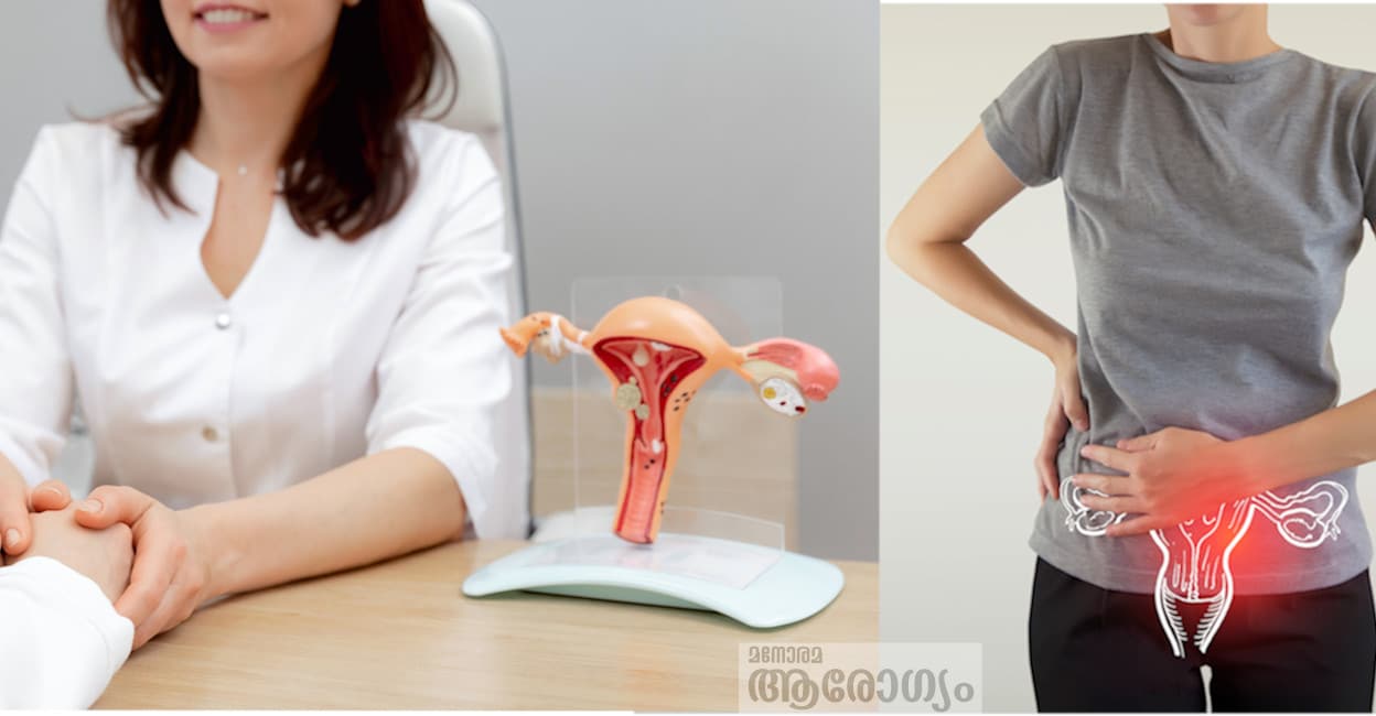 hysterectomy576576