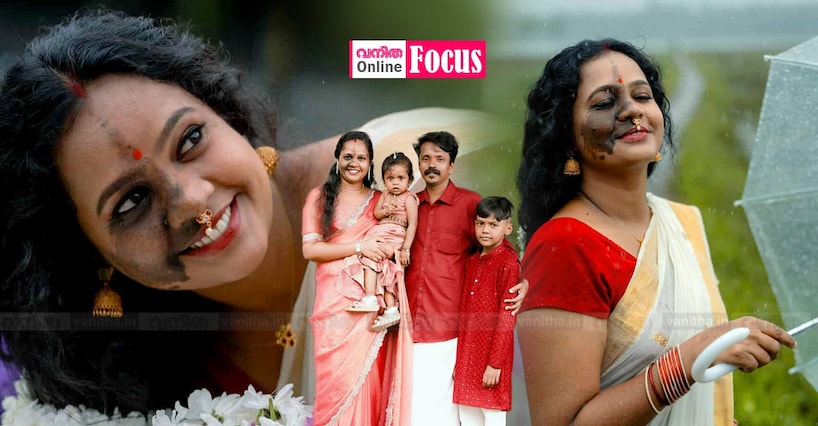 ‘മുഖം പൊള്ളിയതാണോ, ഇനി നല്ലൊരു ചെക്കനെ കിട്ടോ...’: തുറിച്ചു നോട്ടക്കാരെ താണ്ടിയ പുഞ്ചിരി: നിമ്യയെന്നാൽ ആത്മവിശ്വാസം