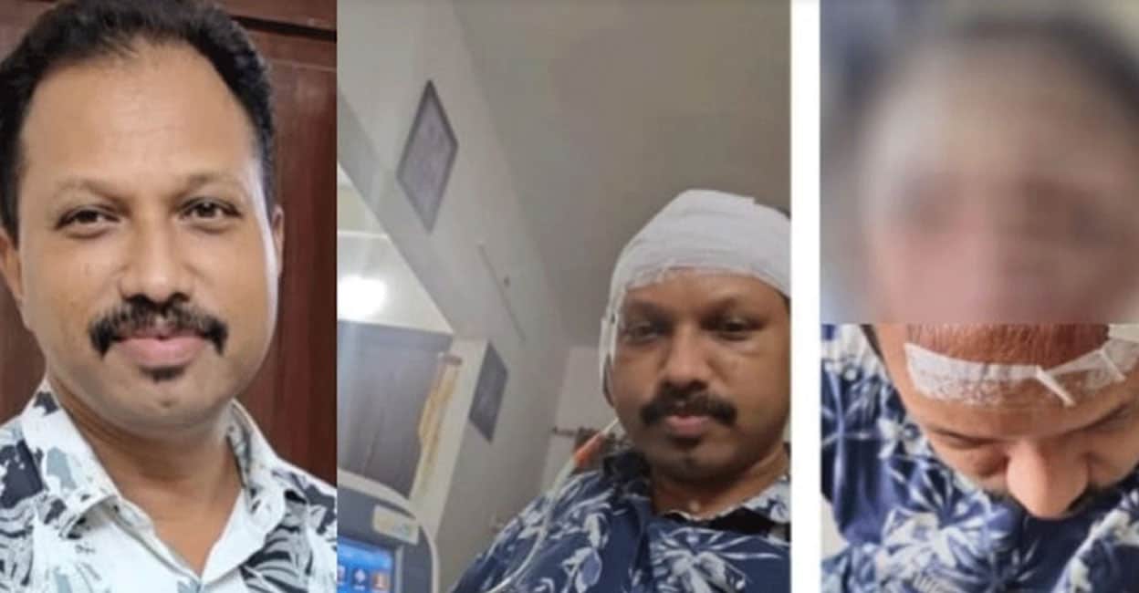sanil-hair-transplant