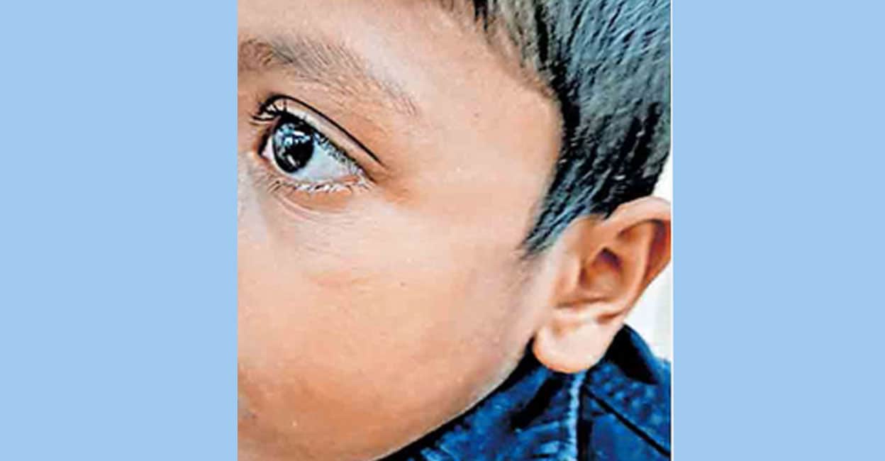 സമീപവാസിയുടെ അടിയേറ്റു കുട്ടിയുടെ കവിളിലുണ്ടായ നീർക്കെട്ട്.
