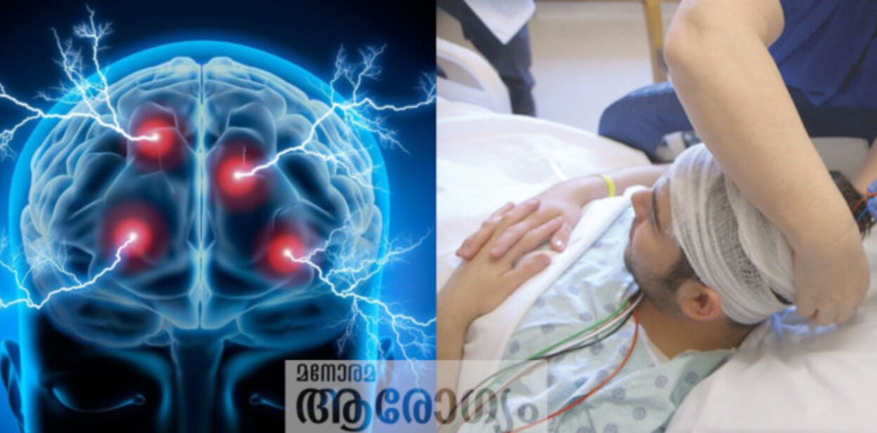 epilepsy67576