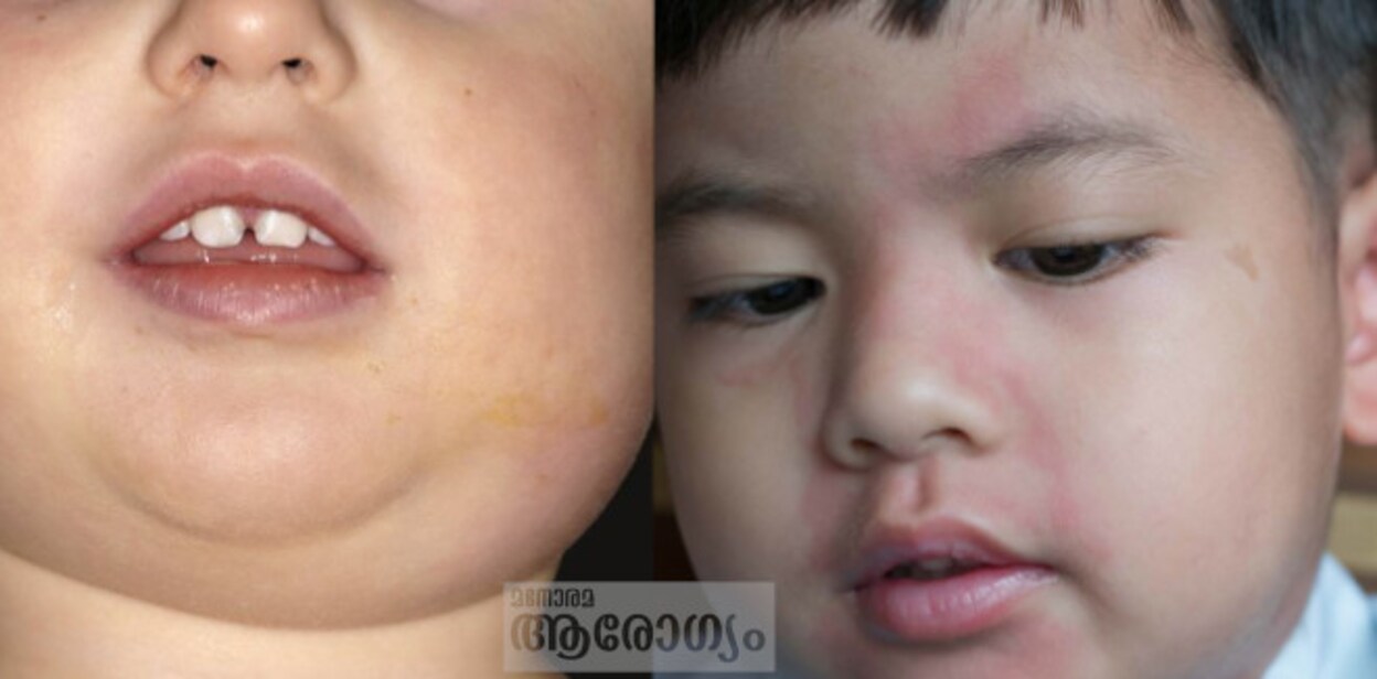 mumps5454